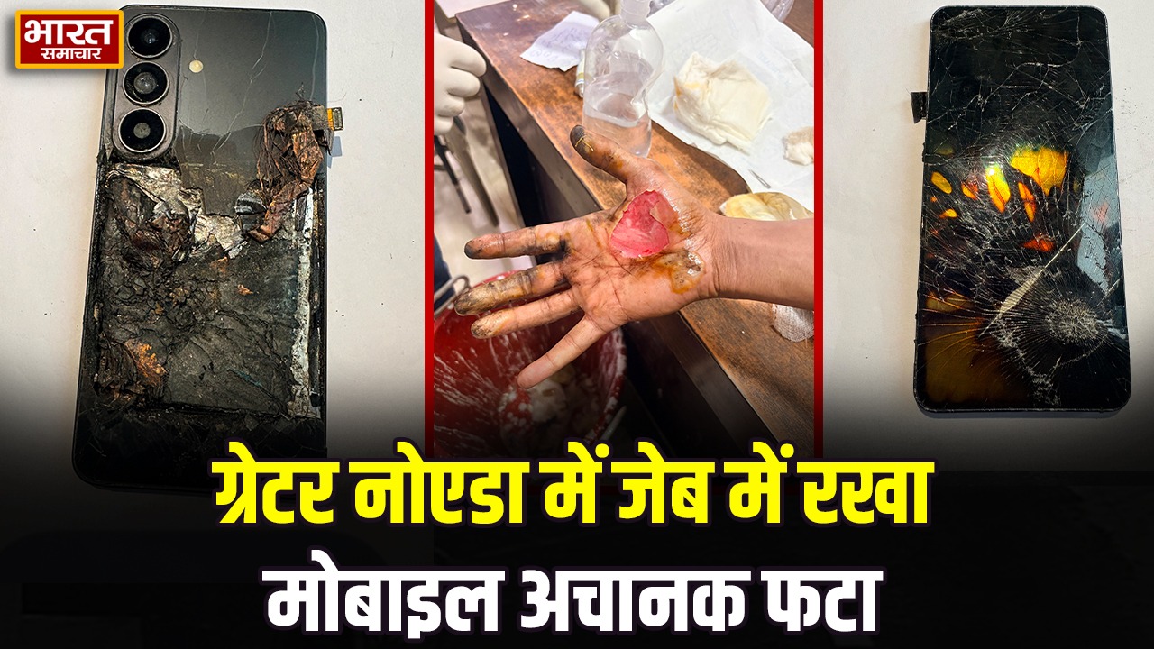 ग्रेटर नोएडा में जेब में रखा मोबाइल अचानक फटा