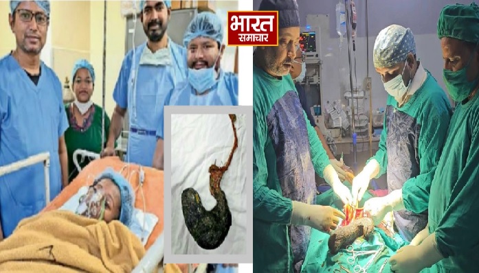 20 साल की छात्रा के पेट से निकला 1.16 किलो का बालों का गुच्छा, 11 साल से खा रही थी बाल